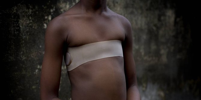 Setrika Payudara, Kekerasan terhadap Perempuan Afrika yang Jarang Disorot