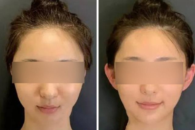 Telinga Peri, Tren Baru Operasi Plastik Anak Muda di China