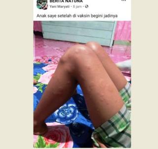 Warga di Natuna Ini Sebut Kaki Anaknya Bentol-bentol Pasca Divaksin Covid