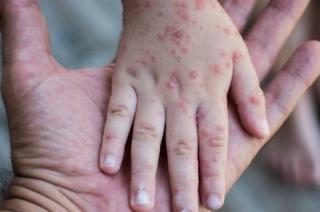 Kadinkes Kepri Imbau Waspadai Flu Singapura Intai Anak-anak