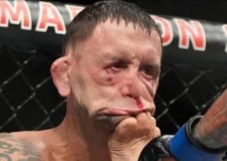 Kena Tendangan Brutal, Wajah Petarung UFC Fankie Edgar Nyaris Tak Dikenali 