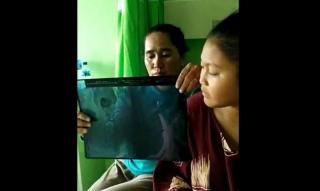 Duh, Gadis di Karimun Ini Tak Sengaja Telan Jarum saat Bermain