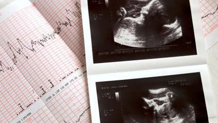 Bukan di Rahim, Wanita Ini Hamil Anaknya di Hati