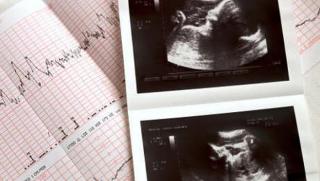 Bukan di Rahim, Wanita Ini Hamil Anaknya di Hati
