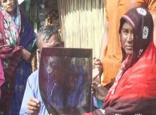 Rasakan Nyeri Selama 20 Tahun, Rupanya Ada Gunting di Perut Wanita Ini