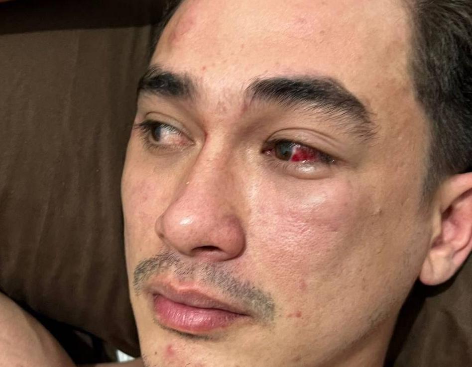 Rico Valentino Hampir Meninggal Dikeroyok, Putra Siregar: Saya Bela