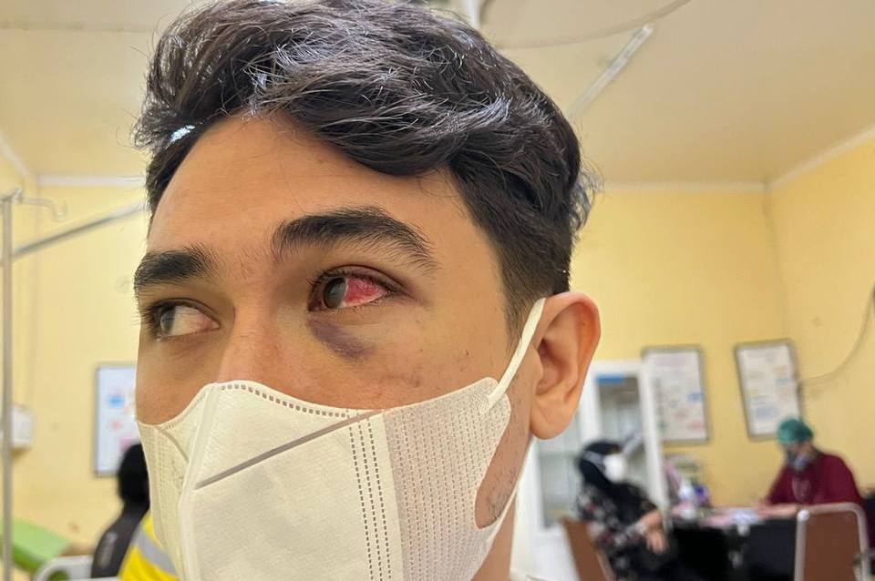 Duluan Lapor Polisi, Pengeroyok Rico Velantino Tak Kunjung Ditangkap Polres Jakarta Selatan, Ada Apa?