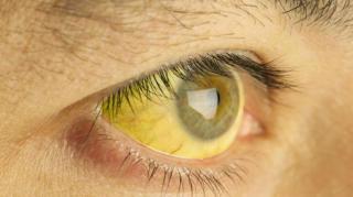 RI Temukan Kasus Hepatitis Akut, Ini Cara Cegahnya