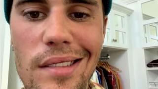 Fakta-fakta Sindrom yang Bikin Wajah Justin Bieber Lumpuh Sebelah