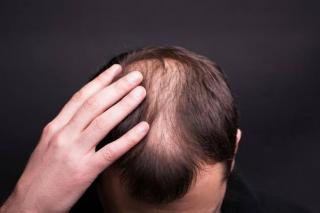 4 Cara Mengatasi Rambut Rontok di Usia Tua