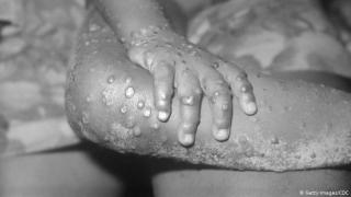 WHO Minta Waspada, Ini Ciri-ciri Ruam Khas Cacar Monyet