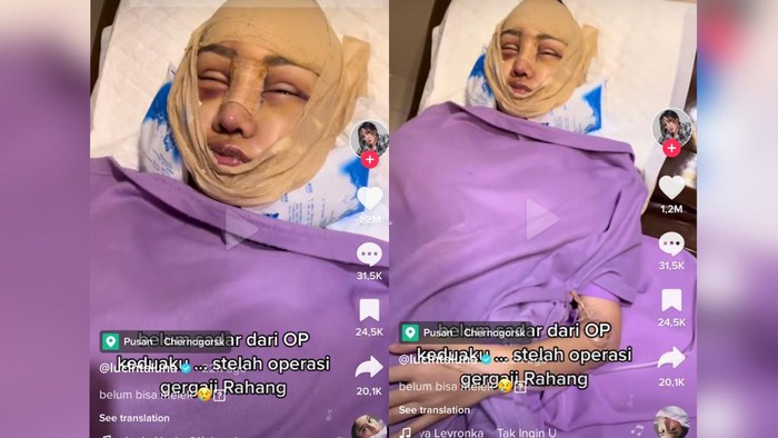 Lucinta Luna Lanjut Operasi, Kali Ini 