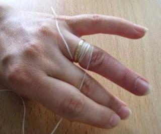 Dokter Sampai Nyerah, Damkar Turun Tangan Lepas Cincin di Alat Vital