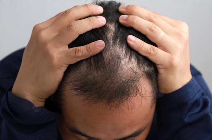 7 Penyebab Rambut Menipis dan Berujung Kebotakan