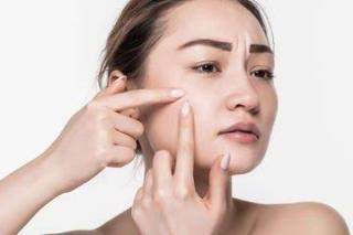 7 Tips Mengatasi Jerawat agar Tak Makin Parah