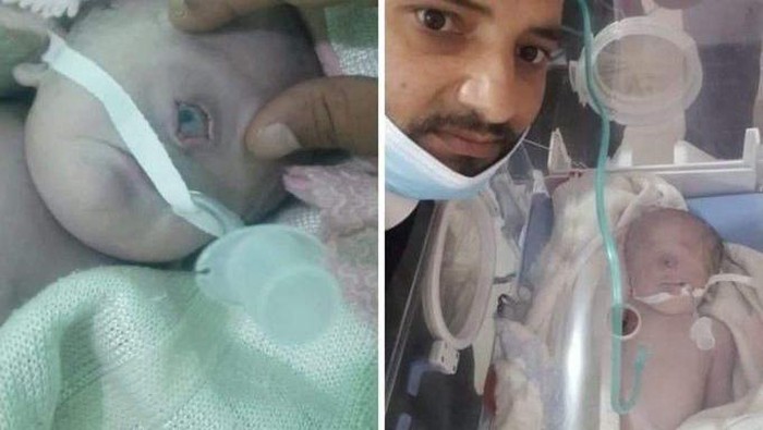 Apa Itu Cyclopia? Heboh Bayi Bermata Satu Lahir di Yaman