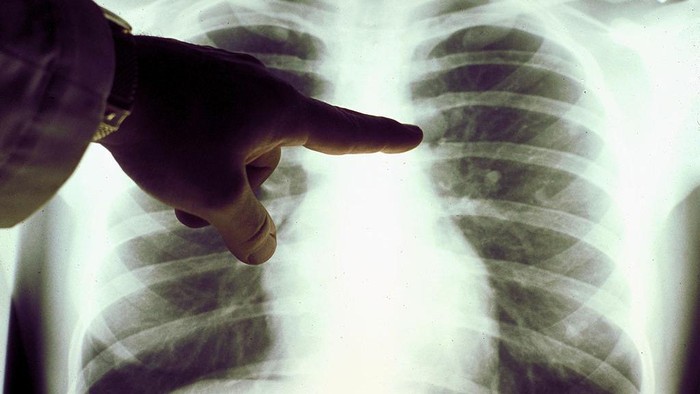 Ngeri! Dokter Paru Sebut Uap Vape Bisa Picu Kondisi Langka 