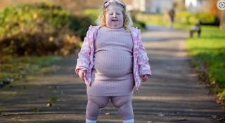 Bocah 5 Tahun Tak Bisa Berhenti Makan, BB-nya Sudah 45 Kg