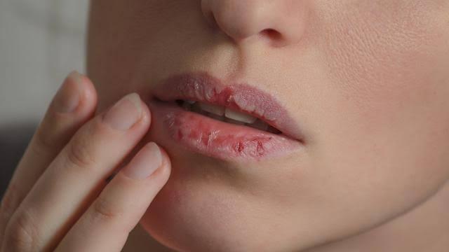 Cara Mudah Mengatasi Bibir Kering saat Berpuasa