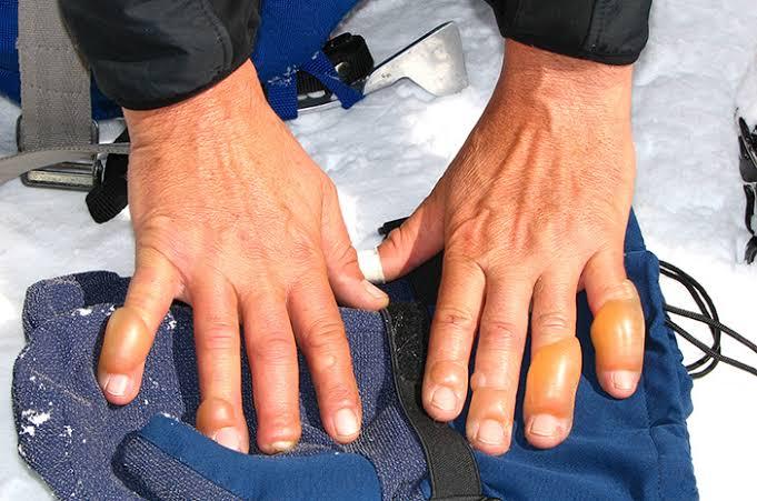 Mengenal Frostbite, Bahaya Dingin yang Mengintai dan Cara Mengatasinya
