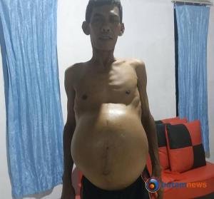 Idap Tumor Ganas, Warga Tanjungbatu di Karimun Butuh Bantuan Dana untuk Berobat