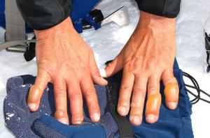 Mengenal Frostbite, Bahaya Dingin yang Mengintai dan Cara Mengatasinya