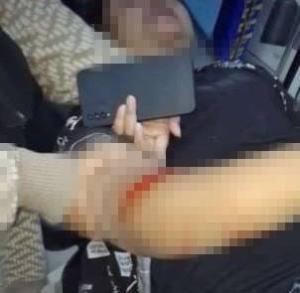 Wanita Dibegal di Tanjungsengkuang: Mengalami Luka Serius dan 15 Jahitan Akibat Serangan Senjata Tajam
