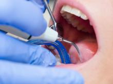 Bersihkan Karang Gigi bisa Pakai BPJS Kesehatan, Ini Panduan dan Syaratnya