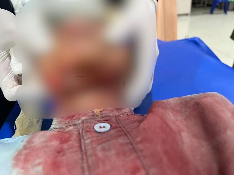 Siswa TK Insan Mulia Karimun Alami Luka Serius, Diduga Akibat Jatuh Saat Bermain