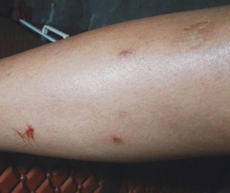 Mpox Kembali Mewabah: WHO Pertimbangkan Status Kedaruratan Kesehatan, Pakar Beri Saran Antisipasi