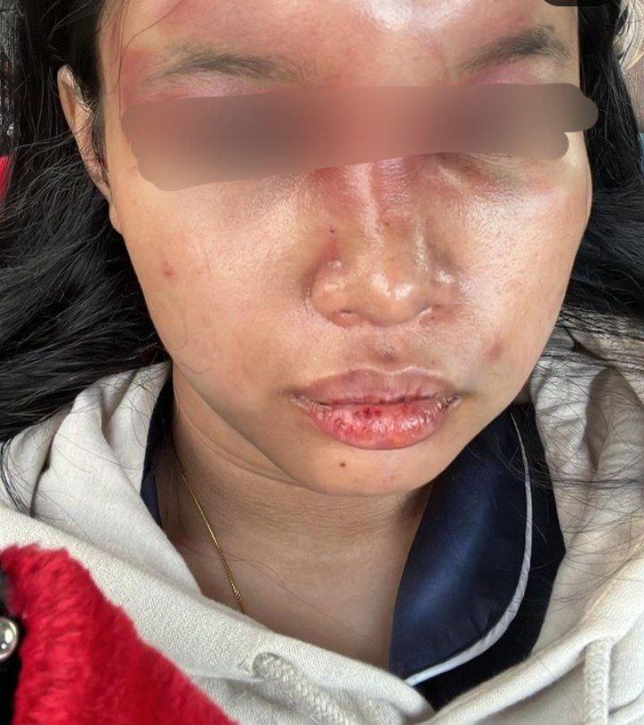 Breaking News: Gadis Batam Dianiaya Mantan Kekasih, Ungkap Pengalaman Pilu di Instagram