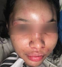 Viral! Penganiayaan Brutal terhadap Yolanda Rindiani, Polsek Batam Kota Berburu Pelaku