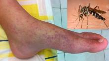 Kenali Gejala Chikungunya, Penyakit yang Ditularkan oleh Nyamuk Aedes Albopictus
