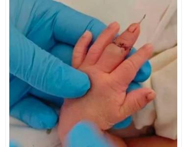 Bidan Potong Jari Bayi Saat Caesar, Alasannya 