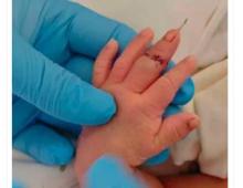 Bidan Potong Jari Bayi Saat Caesar, Alasannya 