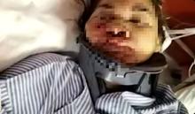 Warga Tanjungpinang Korban Kecelakaan di Malaysia Tertahan di Rumah Sakit, Terkendala Biaya