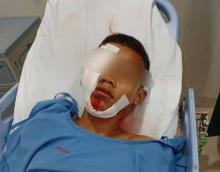 Polisi Selidiki Kecelakaan Viral di Bengkong Laut, Korban Anak Kelas 6 SD Masih Dirawat